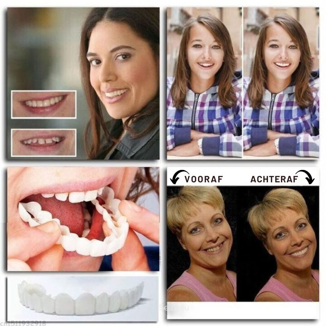 Hoogwaardige cosmetische gebitsprothese, een flexibel en verstelbaar nepgebit voor esthetische tanden.
