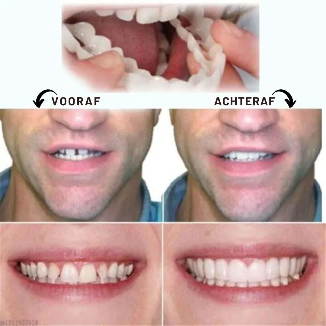 Comfortabele, herbruikbare snap-on gebitsprothese van siliconen, ideaal voor een snelle cosmetische tandenoplossing.