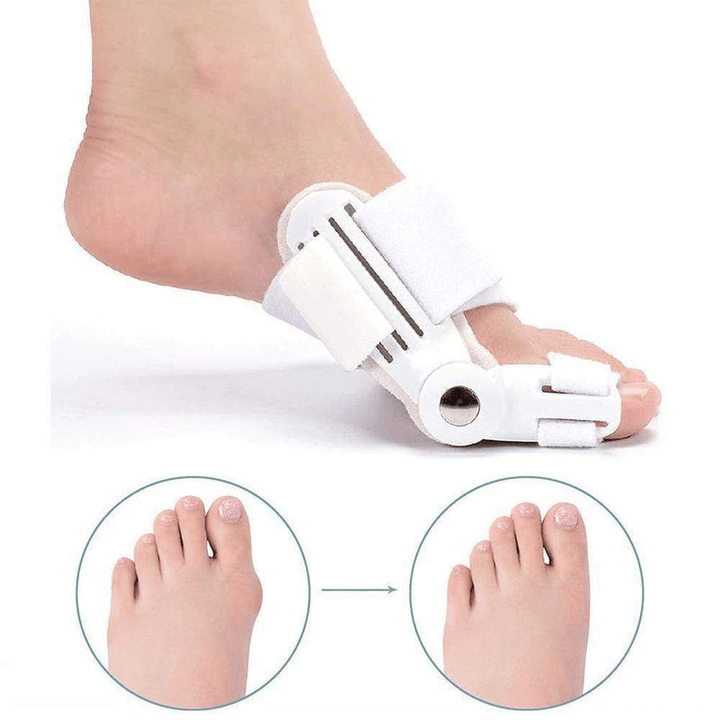 Unisex Corrigerende Spalk voor Hallux Valgus