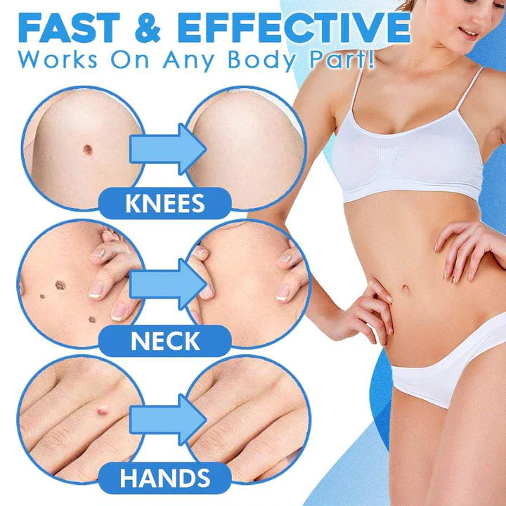 Huidverwijderingskit, pijnloze reiniger, set: verwijderingsbanden, geleideringen, huidtagverwijdering, zacht en effectief.