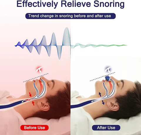 Compact Micro CPAP-apparaat van silicagel, draagbaar, via USB oplaadbaar, ideaal voor snurkvermindering en geschikt voor op reis.