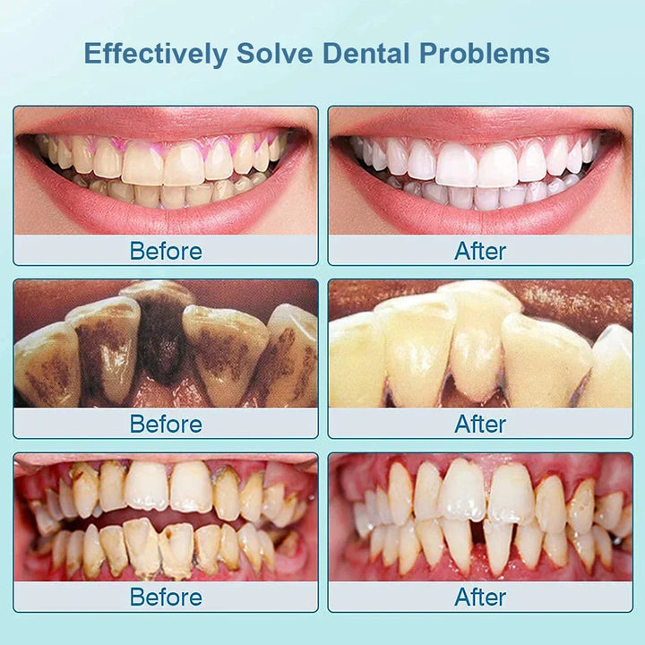 Gebruiksvriendelijke ultrasone tandreiniger SonicClean. Verwijdert plaque en tandsteen effectief voor een gezond gebit.