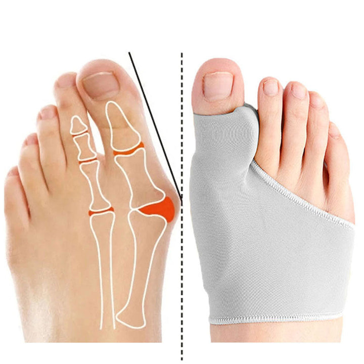 Voetverzorging: Hallux valgus teen corrector gedragen op de voet, toont teen scheiding & correctie.